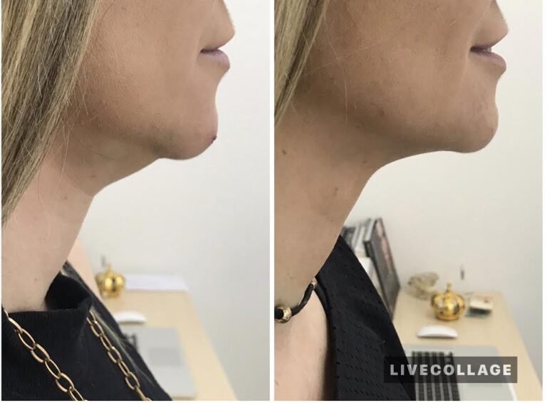 lipo-2