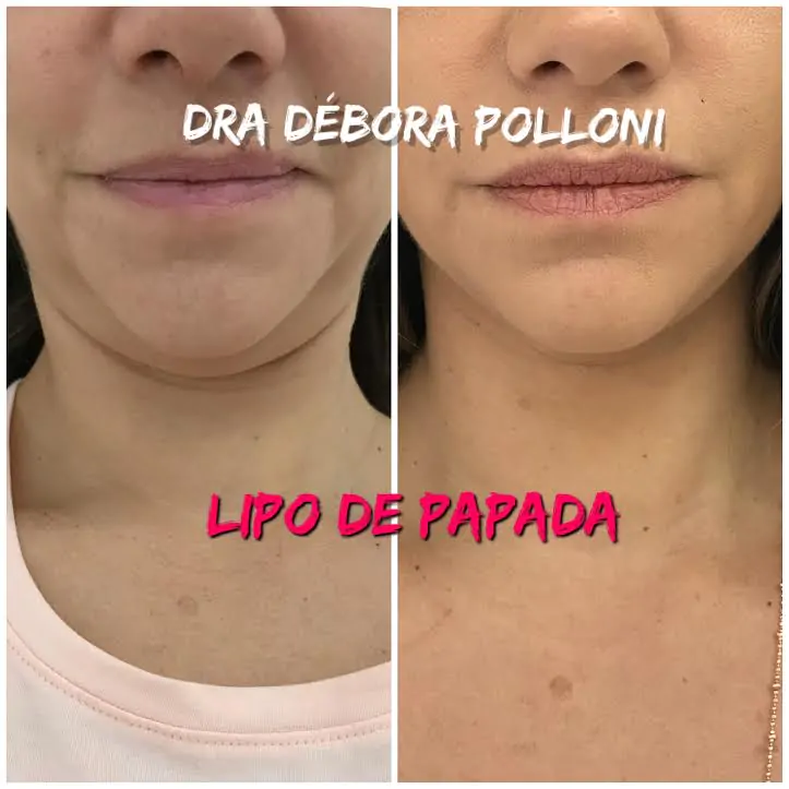 lipo