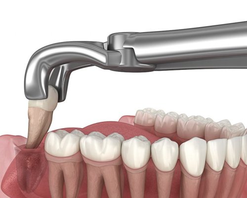 Dente-siso-quando-a-remocao-e-indicada-1024x678