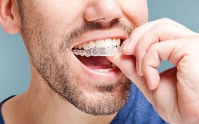 conheca-as-etapas-do-tratamento-com-alinhadores-invisalign-1024x683