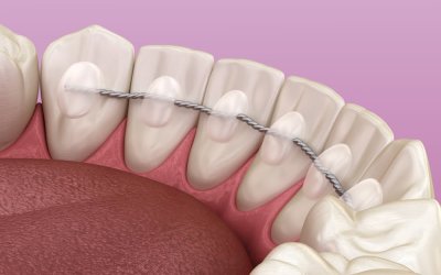 contencao-ortodontica-prima-odonto-campo-grande