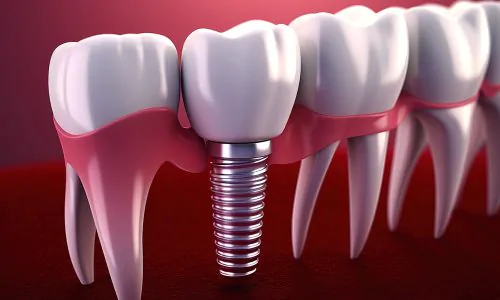 dentes-de-implantacao-dentaria-com-parafuso-de-implante