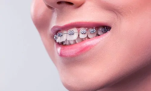 Beautiful young woman with teeth braces on gray