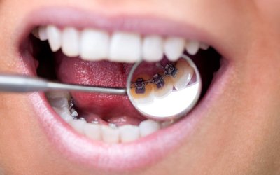 Female patient showing her invisible lingual braces braces on dental mirror
