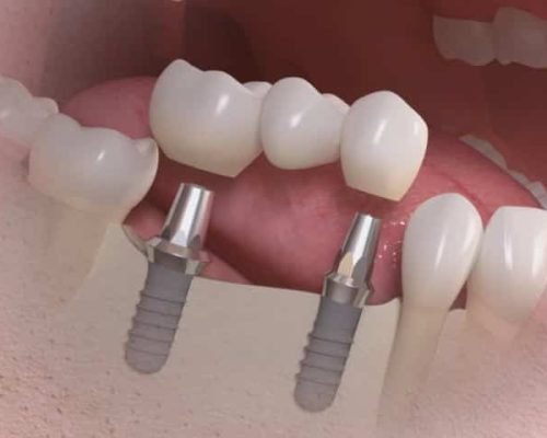 ponte_fixa_sobre_implantes_50kb